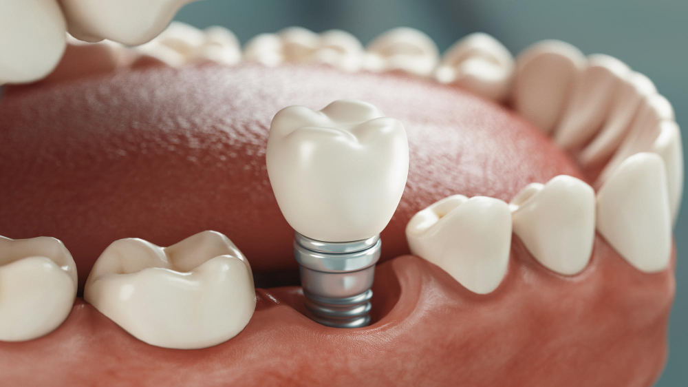 Dental Implants Milpitas, CA