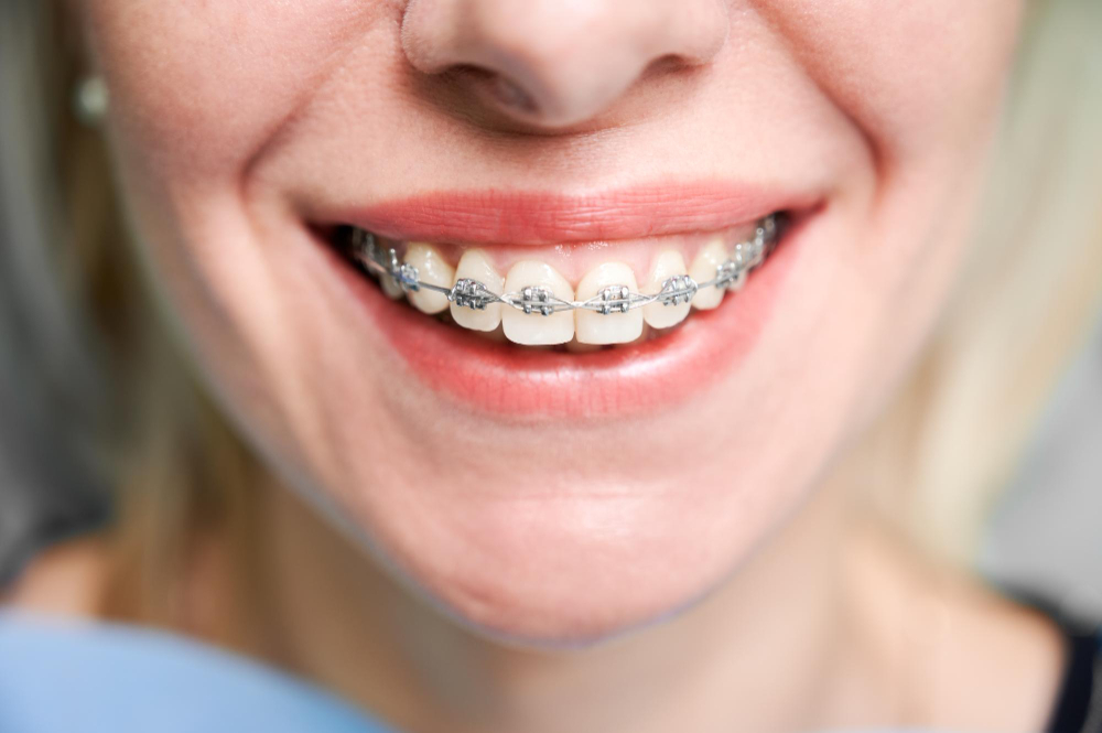 Orthodontic Services in Milpitas