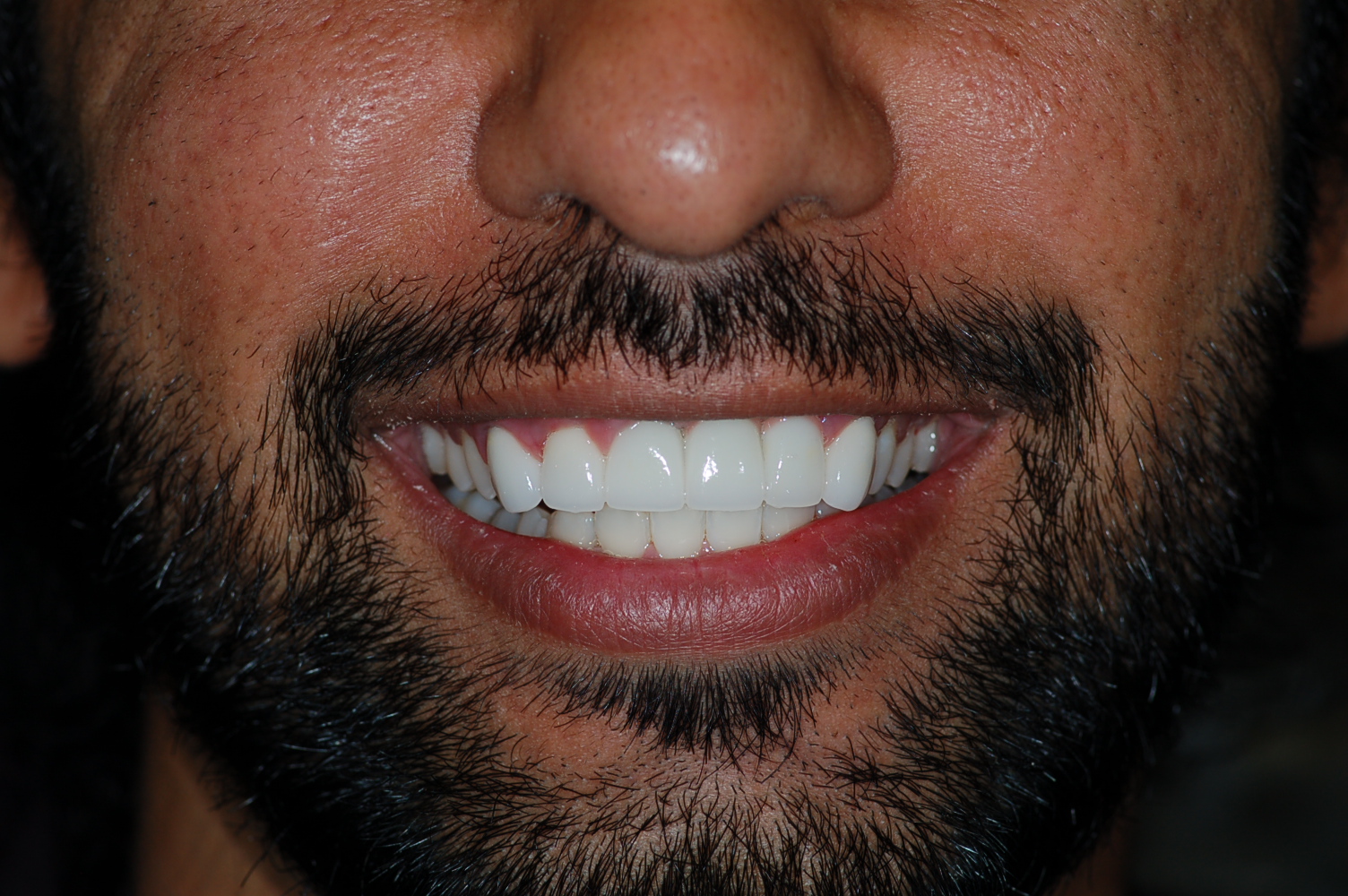 Dental Implants in Milpitas