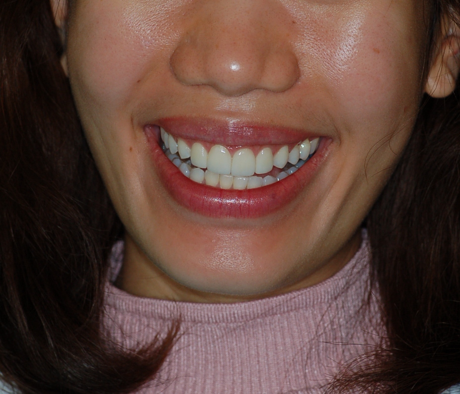 Veneers in Milpitas